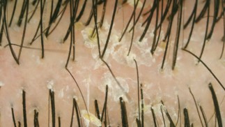 Nahaufnahme von Haaren auf der Kopfhaut mit sichtbaren Schuppen und Hauttrümmern.